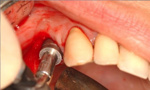 implant dentaire Strasbourg