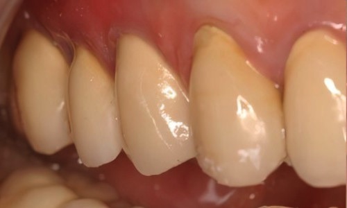 implant dentaire Strasbourg