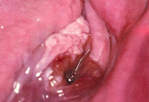 Epithélioma du plancher de la bouche