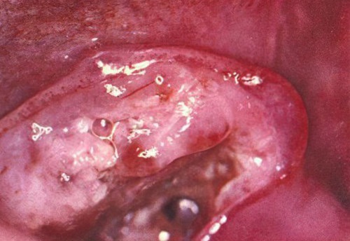 Epithélioma du plancher de la bouche