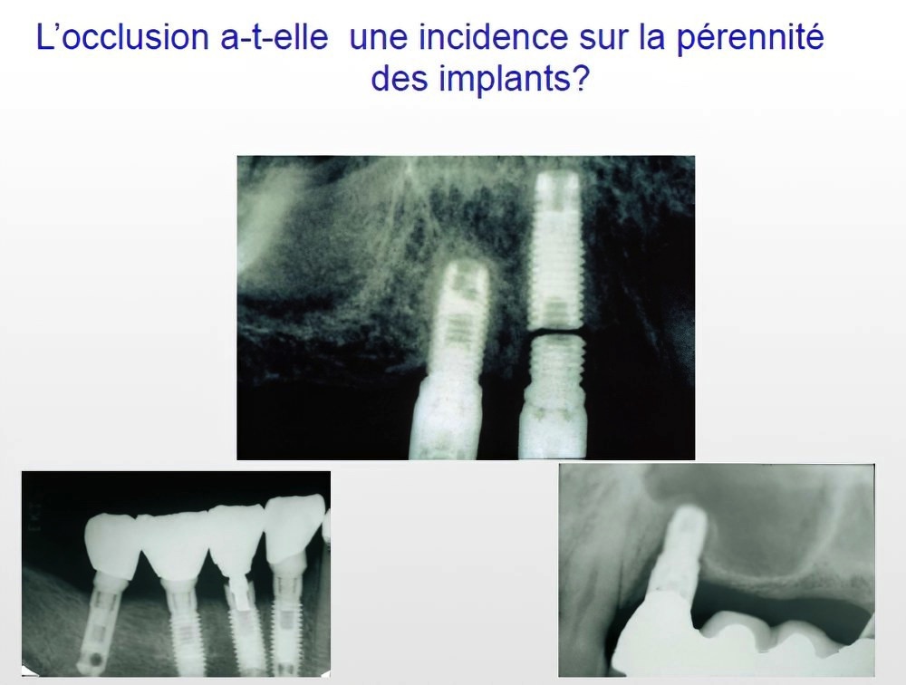 Implantologie dentaire et occlusion