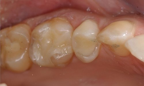 Retrouver un beau sourire Strasbourg restauration inlay