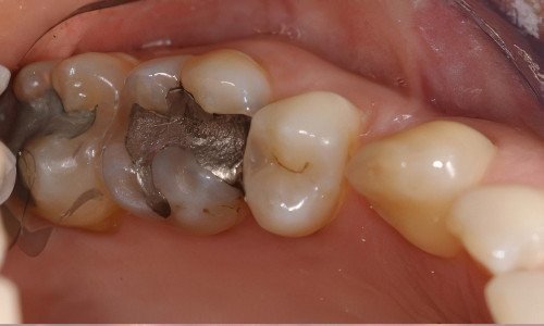 Retrouver un beau sourire Strasbourg restauration inlay