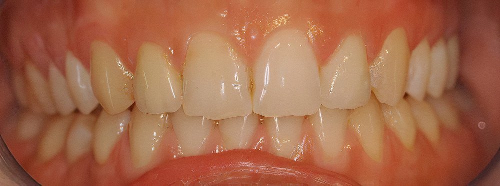 Retrouver un beau sourire Strasbourg Belles dents naturelles