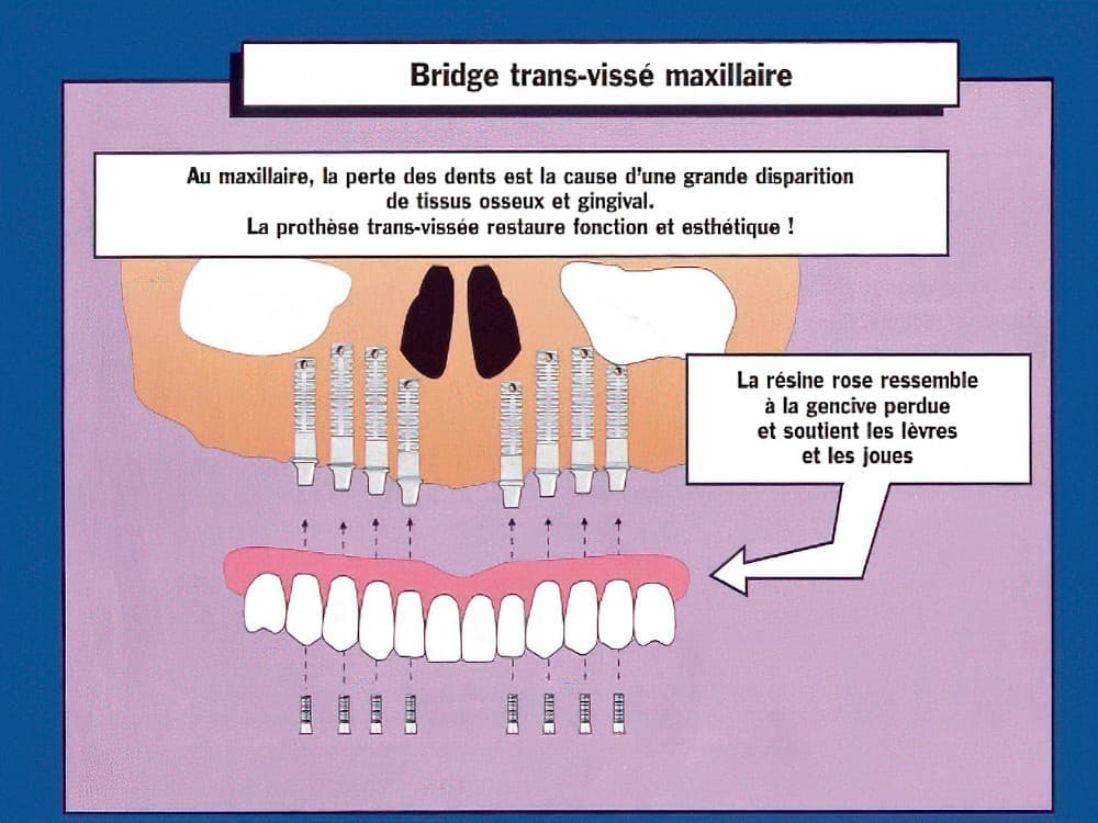Bridge transvissé maxillaire sur implants_ Strasbourg