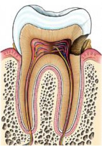 caries dentaires