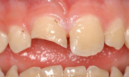 Reconstruire les dents Strasbourg Composite anterieur avant tr