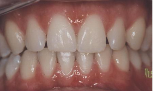 dents naturelles