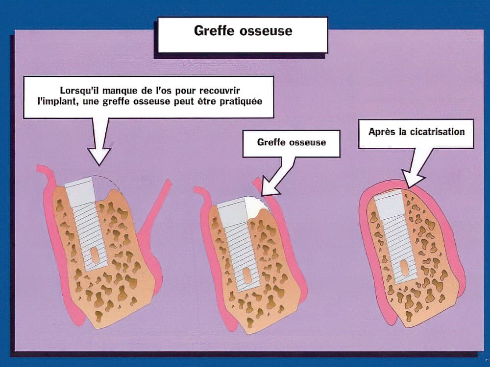 Greffe osseuse dentaire Strasbourg