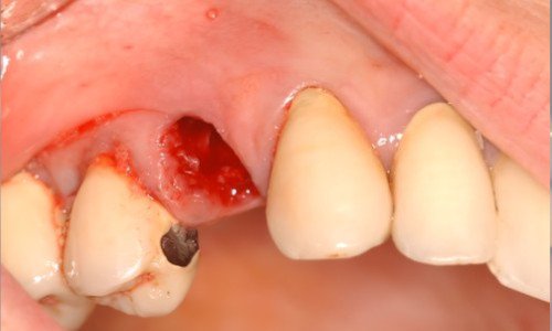 Reconstruire les dents implant dentaire Strasbourg