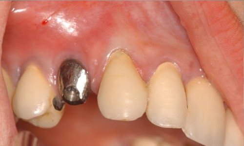 Reconstruire les dents iStrasbourg mplant dentaire