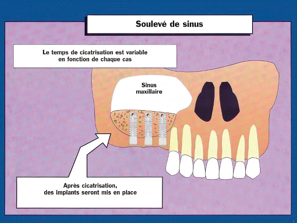 implants dentaires Strasbourg sinus et greffe