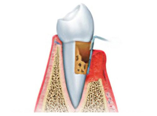 Traitement des maladies parodontales