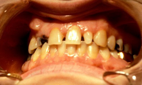 orthodontie adulte Strasbourg Retrouver un beau sourire