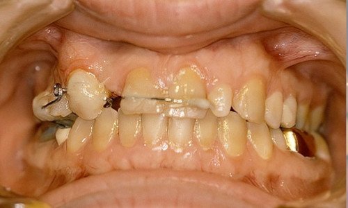 Retrouver un beau sourire Strasbourg orthodontie adulte