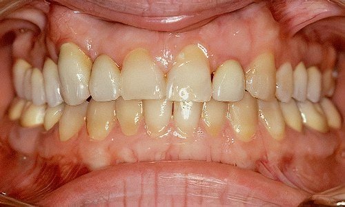 Retrouver un beau sourire orthodontie adulte Strasbourg