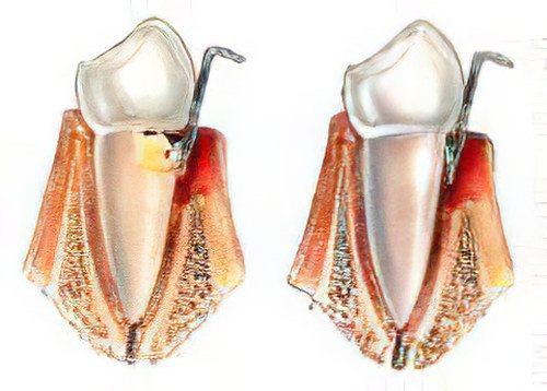 Traitement Maladie Parodontale Strasbourg